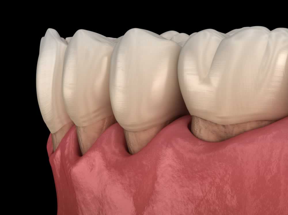 periodontis